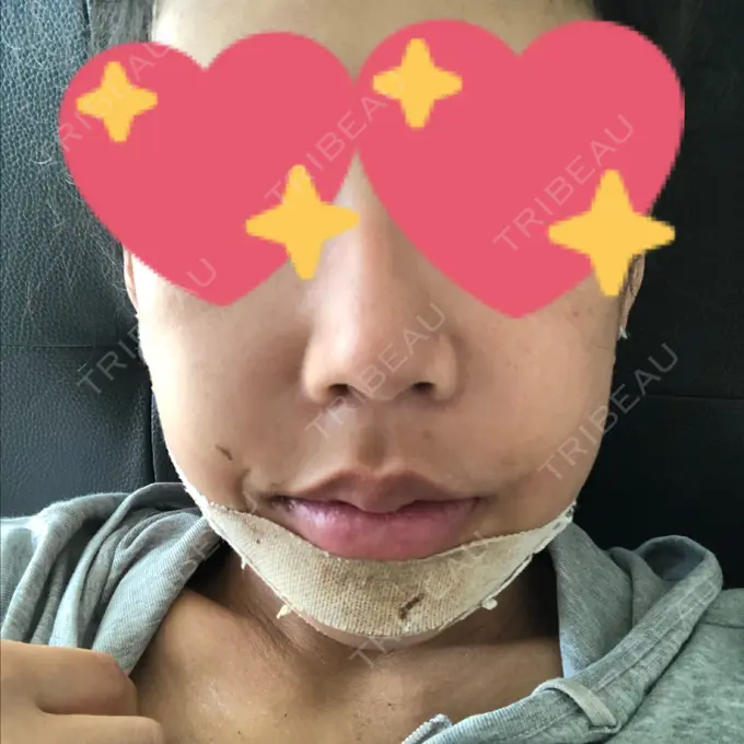 ルフォー+ssro（両あご) / その他（輪郭） View美容整形外科 DAY 7 メイン用