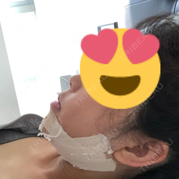 ルフォー+ssro（両あご) / その他（輪郭） View美容整形外科 DAY 5 メイン用