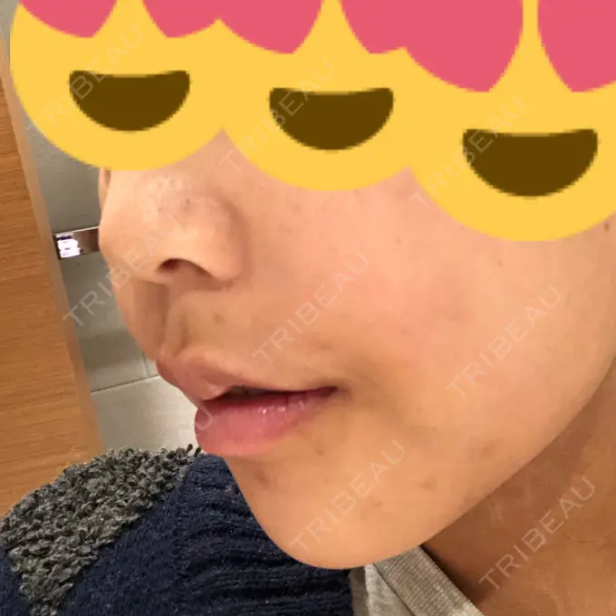 ルフォー+ssro（両あご) / その他（輪郭） View美容整形外科 AFTER メイン用