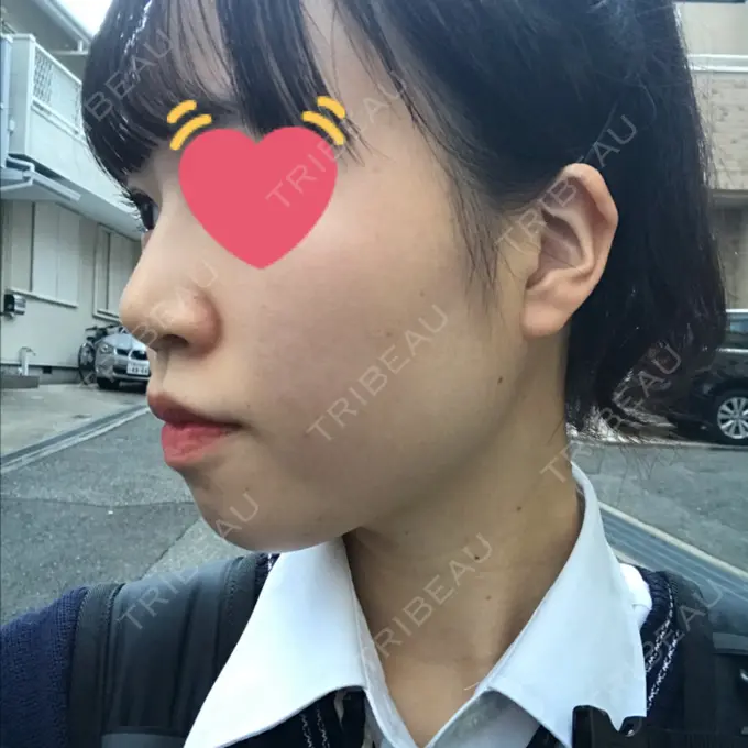 鼻尖縮小 / ヒアルロン酸注入（鼻） 東京ヒルズクリニック 岡崎院 DAY 10 メイン用