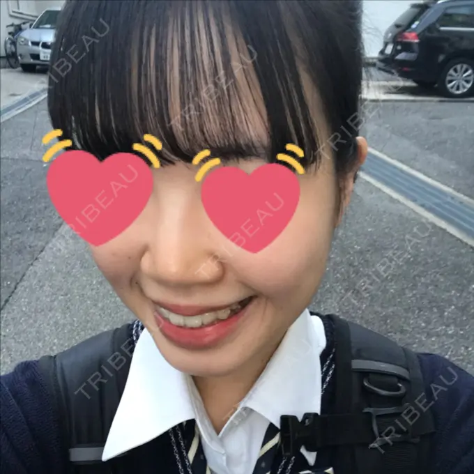 鼻尖縮小 / ヒアルロン酸注入（鼻） 東京ヒルズクリニック 岡崎院 DAY 10 メイン用