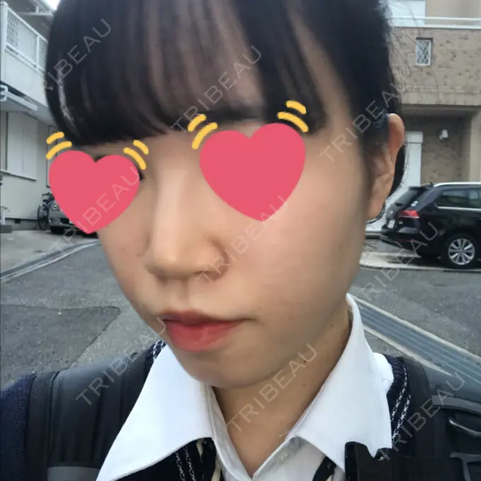 ヒアルロン酸注入（鼻） 東京ヒルズクリニック 岡崎院 AFTER メイン用