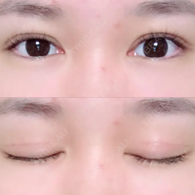 二重切開 / 上まぶたの脂肪取り / その他（目元） 湘南美容クリニック 新宿本院 DAY 75 メイン用