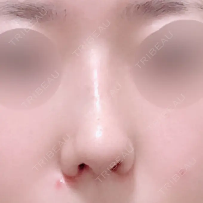 鼻中隔延長（切開） / 小鼻縮小（切開） / 軟骨移植 / 骨切幅寄せ / 鼻尖縮小 / 鼻孔縁下降 加美（GAMI）整形外科 DAY 30 メイン用