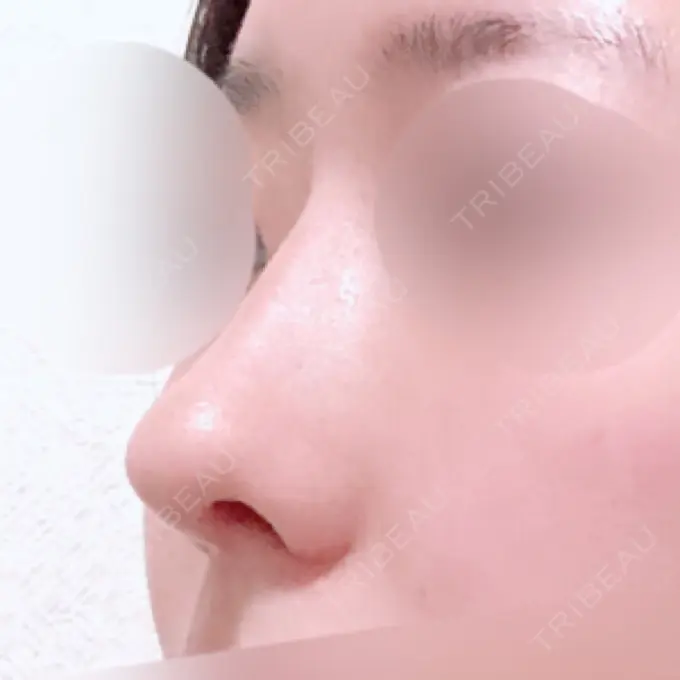 鼻中隔延長（切開） / 小鼻縮小（切開） / 軟骨移植 / 骨切幅寄せ / 鼻尖縮小 / 鼻孔縁下降 加美（GAMI）整形外科 DAY 30 メイン用