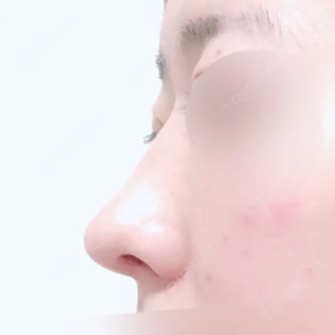 鼻中隔延長（切開） / 小鼻縮小（切開） / 軟骨移植 / 骨切幅寄せ / 鼻尖縮小 / 鼻孔縁下降 加美（GAMI）整形外科 DAY 30 メイン用