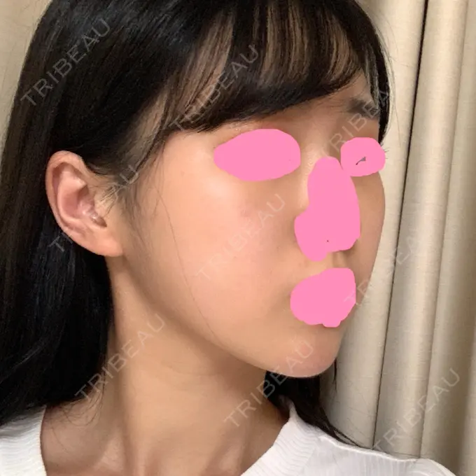 脂肪吸引（顔） / ボトックス（あご） / ヒアルロン酸注入（あご） / ボトックス（エラ・小顔） プチパーティー医院 DAY 89 メイン用