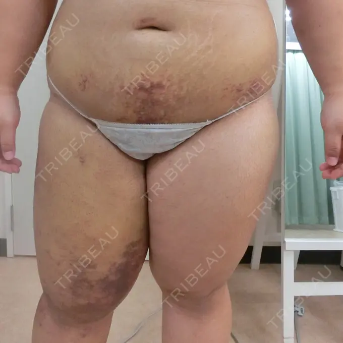 バッカルファット除去 / 脂肪吸引（顔） / 脂肪吸引（二の腕） / 脂肪吸引（脚） / 脂肪吸引（お腹） ジョウクリニック 那覇院 AFTER メイン用