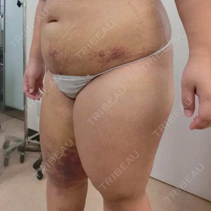 バッカルファット除去 / 脂肪吸引（顔） / 脂肪吸引（二の腕） / 脂肪吸引（脚） / 脂肪吸引（お腹） ジョウクリニック 那覇院 DAY 9 メイン用