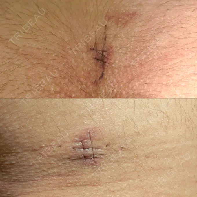 バッカルファット除去 / 脂肪吸引（顔） / 脂肪吸引（二の腕） / 脂肪吸引（脚） / 脂肪吸引（お腹） ジョウクリニック 那覇院 DAY 9 メイン用