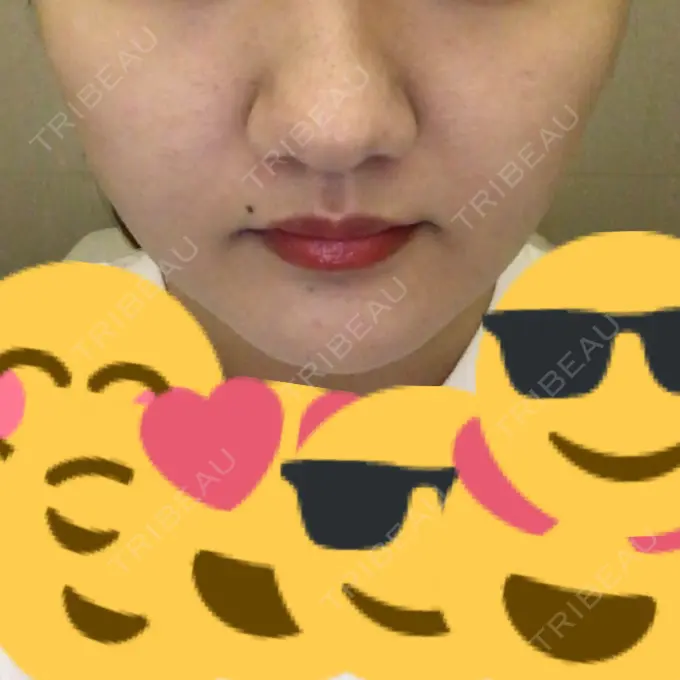 脂肪吸引（顔） アサミ美容外科 渋谷院 DAY 31 メイン用