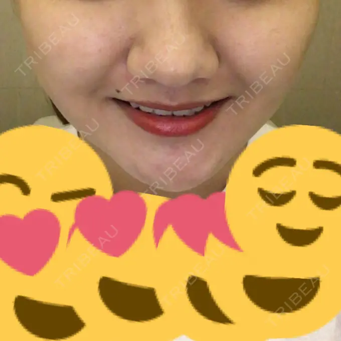 脂肪吸引（顔） アサミ美容外科 渋谷院 AFTER メイン用