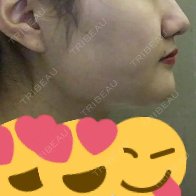 脂肪吸引（顔） アサミ美容外科 渋谷院 DAY 31 メイン用