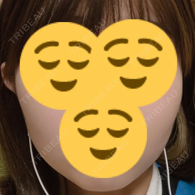 ボトックス（エラ・小顔） もとび美容外科クリニック 新宿院 DAY 1 メイン用