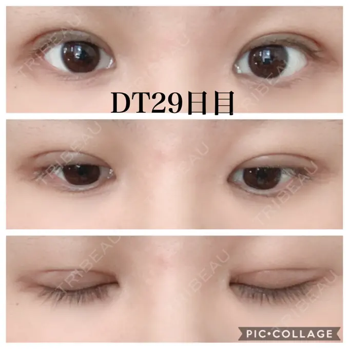 二重切開 水の森美容クリニック 名古屋院 DAY 28 メイン用