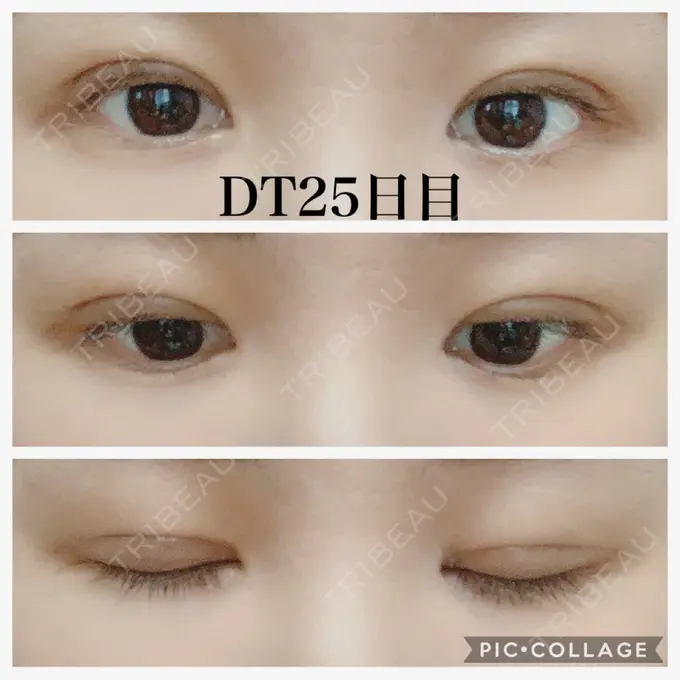 二重切開 水の森美容クリニック 名古屋院 DAY 28 メイン用