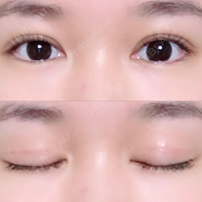 二重切開 / 上まぶたの脂肪取り / その他（目元） 湘南美容クリニック 新宿本院 DAY 80 メイン用