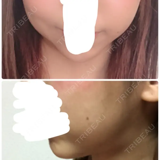 バッカルファット除去 / 脂肪吸引（顔） / ハイフ（顔） THE PLAN（ザ・プラン）美容整形外科・皮膚科 DAY 91 メイン用