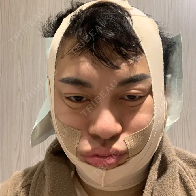 脂肪吸引（顔） THE CLINIC（ザ・クリニック） 東京院 DAY 0 メイン用