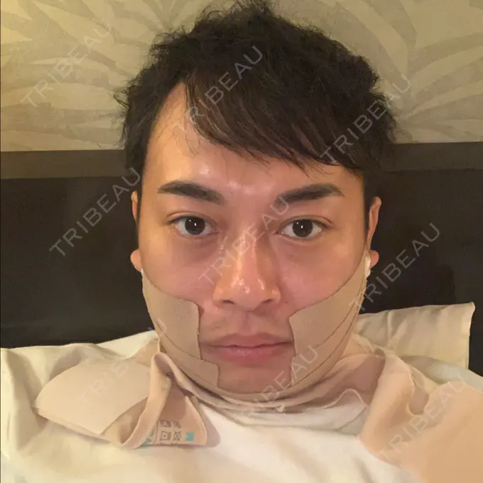 脂肪吸引（顔） THE CLINIC（ザ・クリニック） 東京院 DAY 1 メイン用