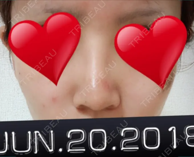 隆鼻術 / 鼻中隔延長（切開） / 軟骨移植 ジュエリー美容外科 DAY 13 メイン用