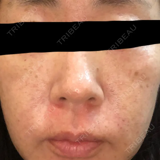 再生医療 RDクリニック大阪 DAY 14 メイン用