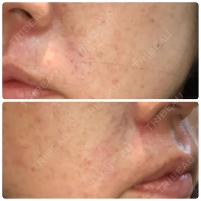 再生医療 RDクリニック大阪 DAY 14 メイン用