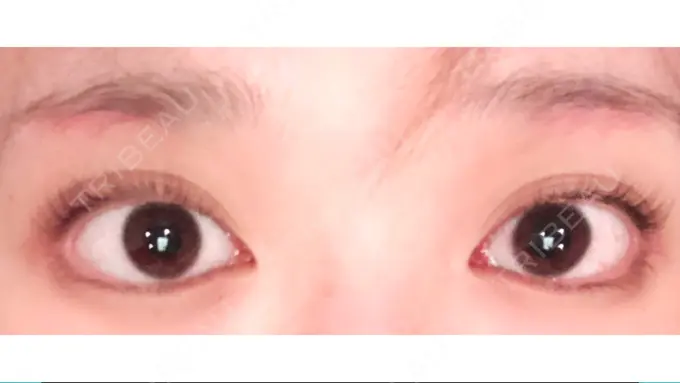 眉下切開 / その他（目元） 湘南美容クリニック 秋葉原院 DAY 39 メイン用