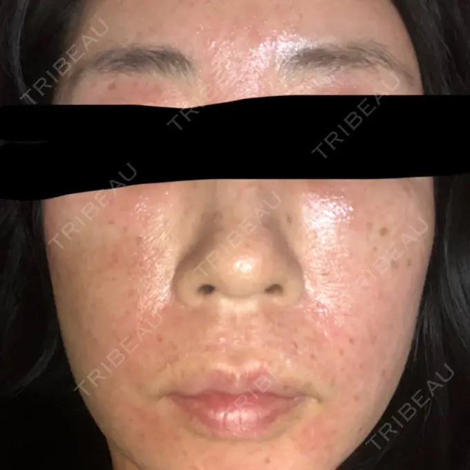 再生医療 RDクリニック大阪 DAY 16 メイン用