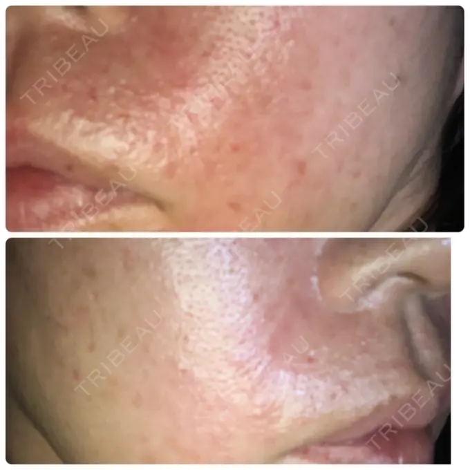 再生医療 RDクリニック大阪 DAY 16 メイン用