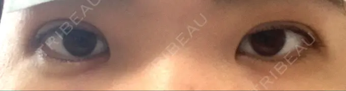 二重埋没 湘南美容クリニック 二子玉川院 DAY 0 メイン用