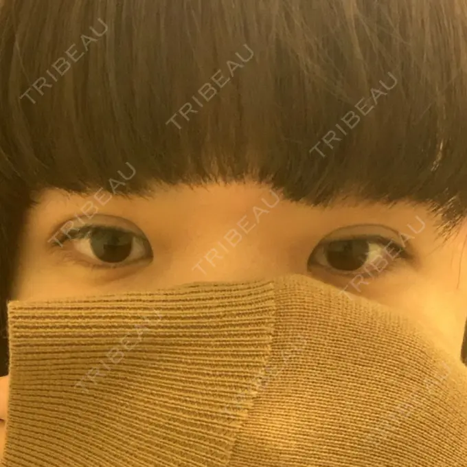 二重埋没 湘南美容クリニック 二子玉川院 DAY 0 メイン用