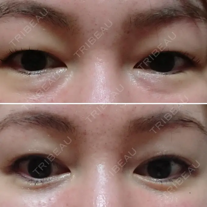 クマ治療 / 下まぶたたるみ取り / 下まぶたの脂肪取り / 脂肪注入（肌） コスメディカルクリニック シンシア 銀座院 AFTER メイン用