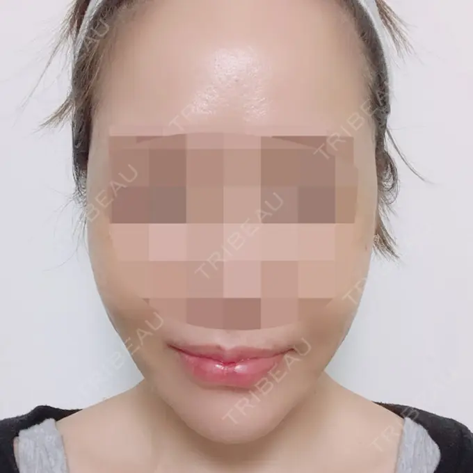 骨切り（あご） / 骨削り（エラ） / 骨削り（頬） シンデレラ美容整形外科 DAY 150 メイン用