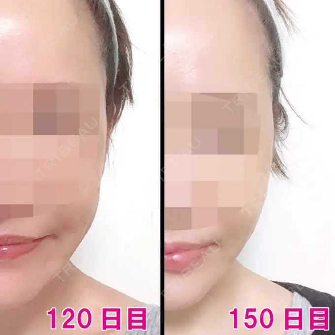 骨切り（あご） / 骨削り（エラ） / 骨削り（頬） シンデレラ美容整形外科 DAY 150 メイン用