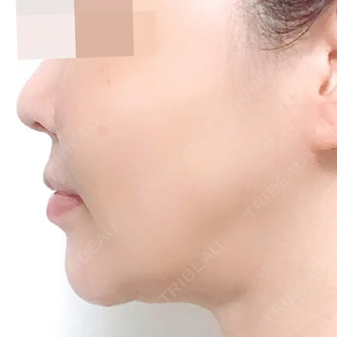 骨切り（あご） / 骨削り（エラ） / 骨削り（頬） シンデレラ美容整形外科 DAY 150 メイン用