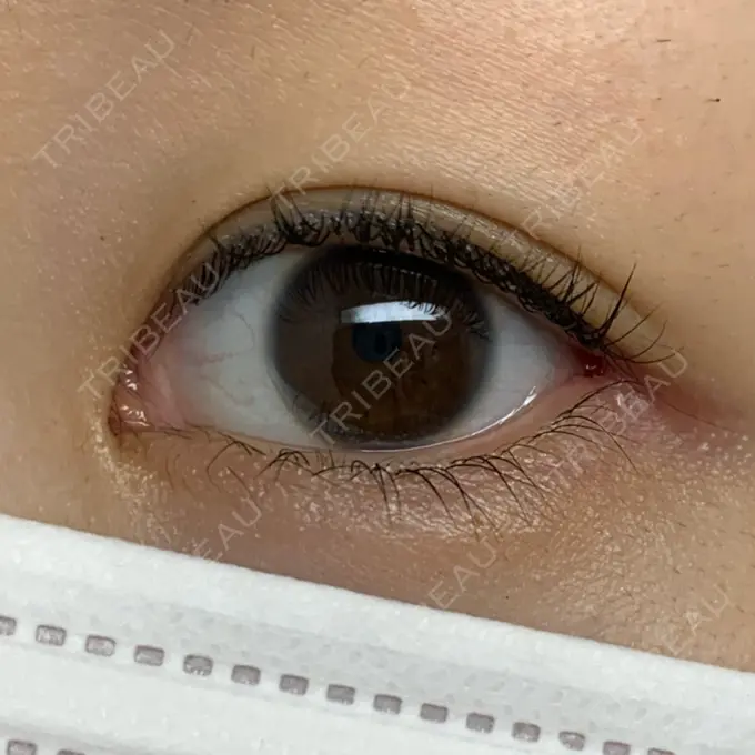 目尻切開 湘南美容クリニック 表参道院 DAY 7 メイン用