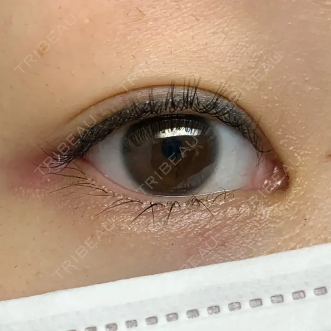 目尻切開 湘南美容クリニック 表参道院 DAY 7 メイン用