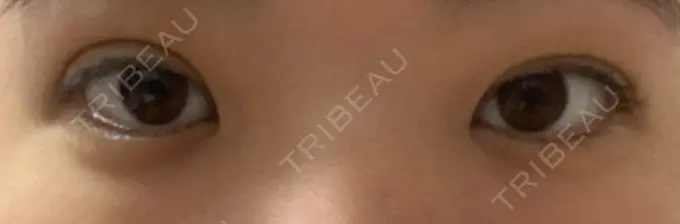 二重埋没 湘南美容クリニック 二子玉川院 AFTER メイン用