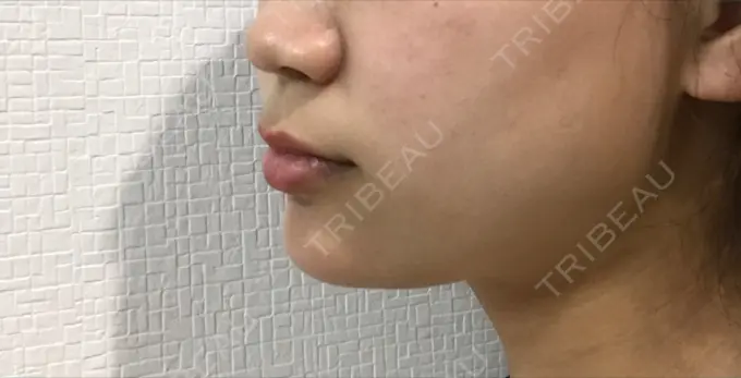 あごプロテーゼ 北尾クリニック DAY 140 メイン用