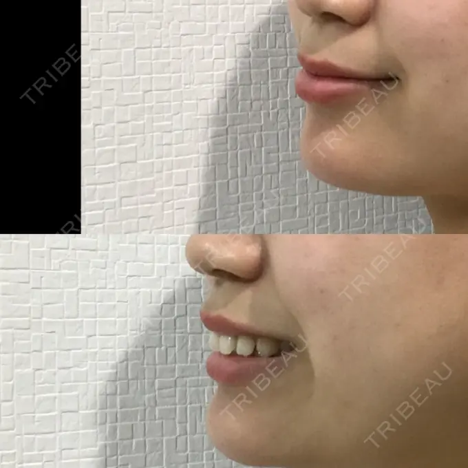 あごプロテーゼ 北尾クリニック DAY 140 メイン用