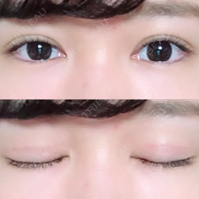 二重切開 / 上まぶたの脂肪取り / その他（目元） 湘南美容クリニック 新宿本院 DAY 85 メイン用
