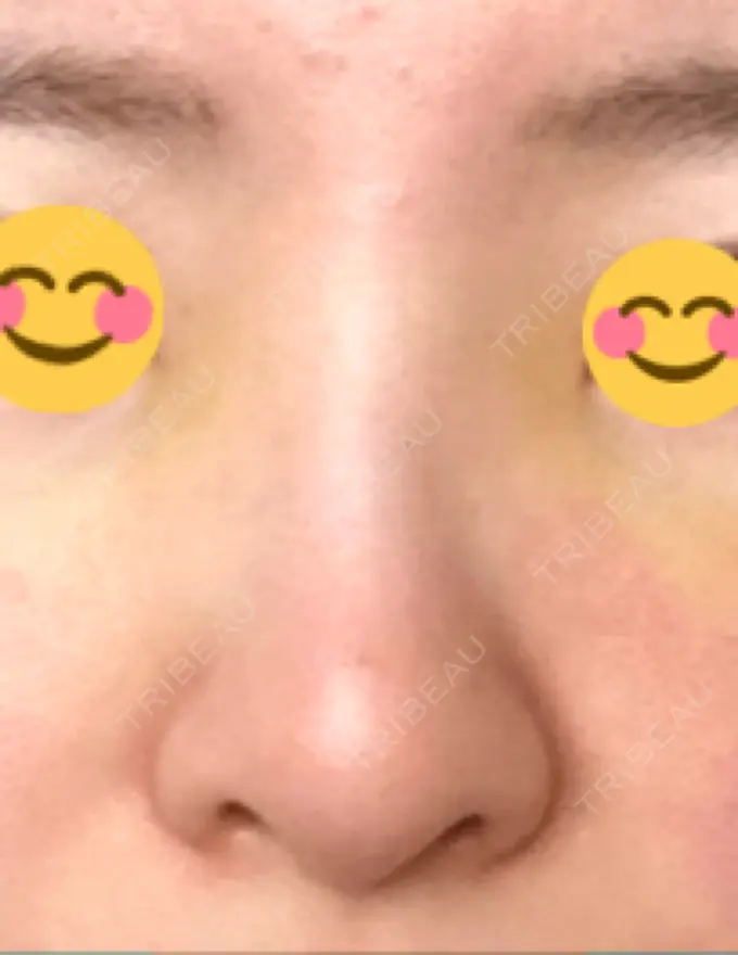 ヒアルロン酸注入（鼻） BIANCA銀座 DAY 4 メイン用