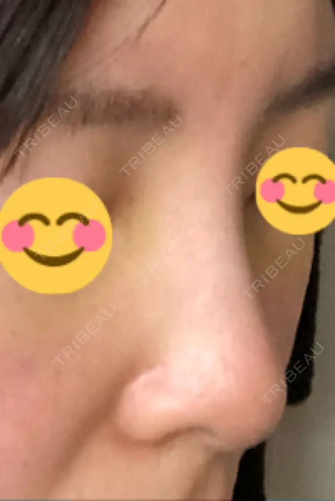 ヒアルロン酸注入（鼻） BIANCA銀座 DAY 4 メイン用