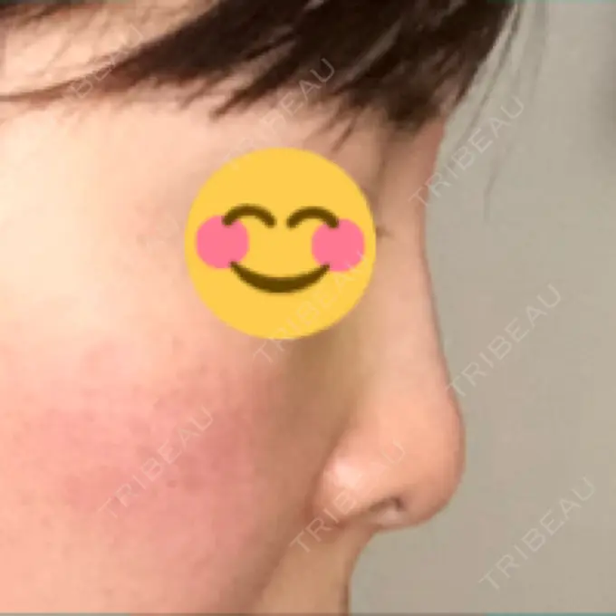 ヒアルロン酸注入（鼻） BIANCA銀座 DAY 4 メイン用