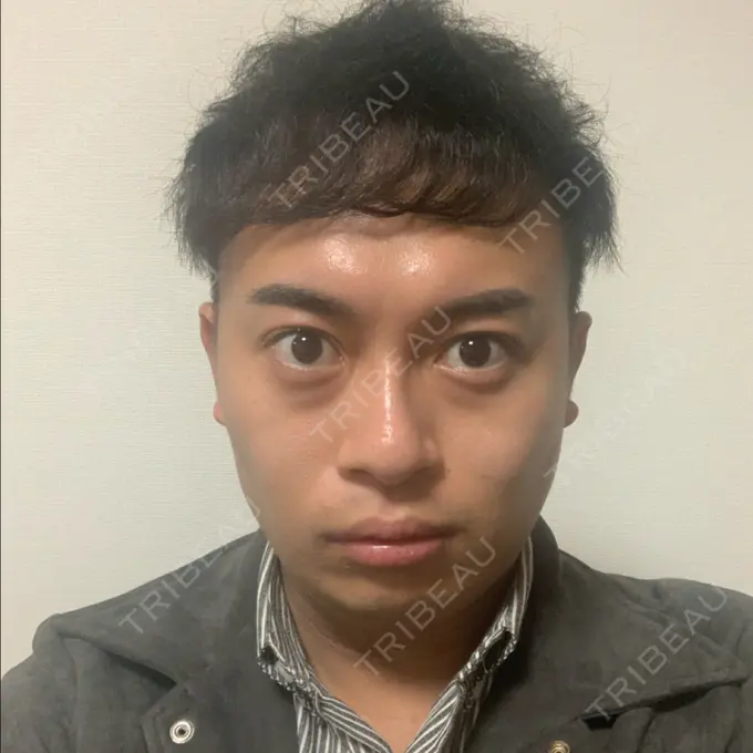 脂肪吸引（顔） THE CLINIC（ザ・クリニック） 東京院 DAY 6 メイン用