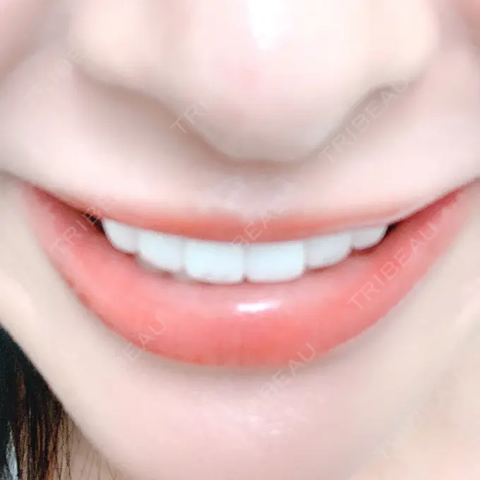 矯正（ワイヤー） / セラミック 東京美容外科 赤坂院 AFTER メイン用