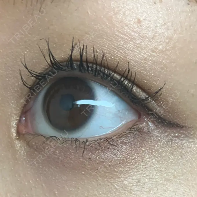 目尻切開 湘南美容クリニック 表参道院 DAY 10 メイン用