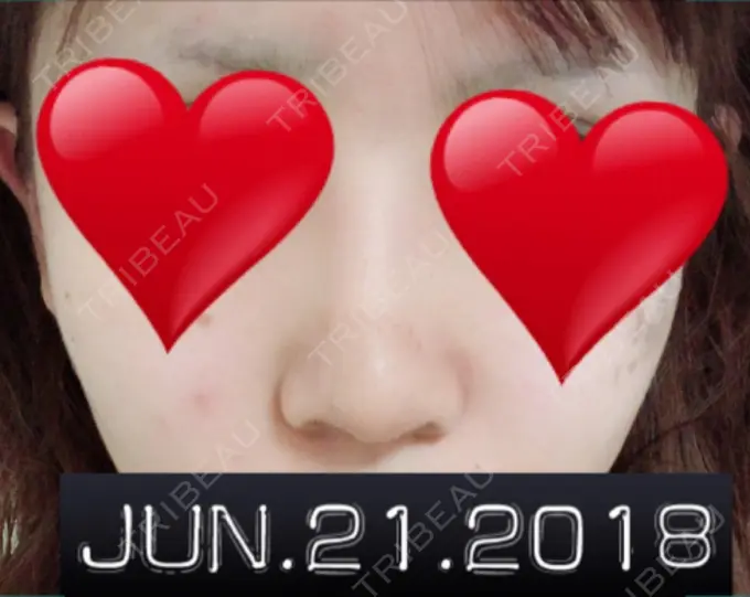 隆鼻術 / 鼻中隔延長（切開） / 軟骨移植 ジュエリー美容外科 DAY 14 メイン用