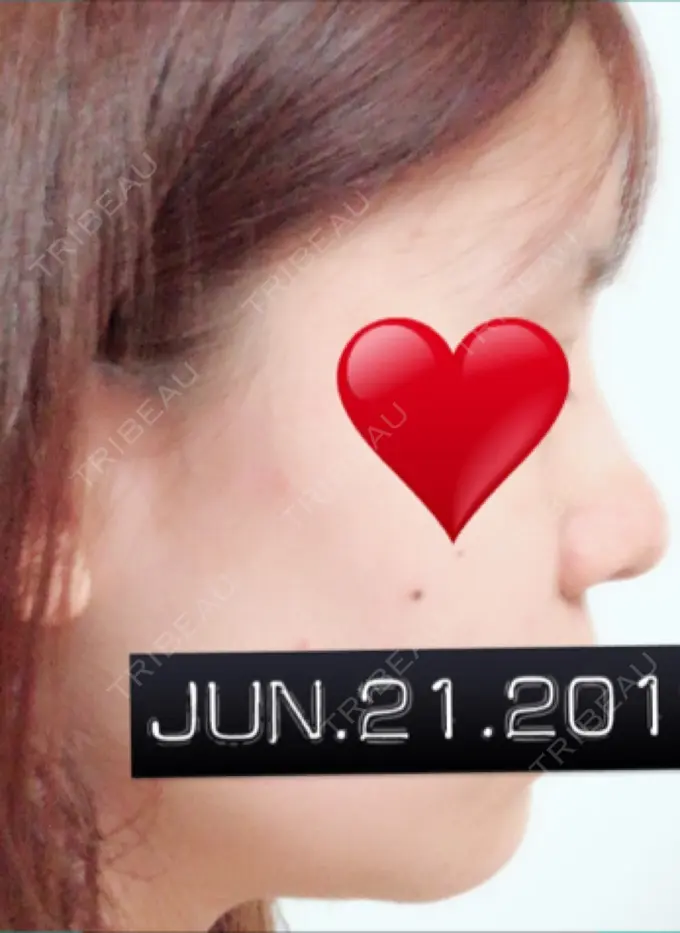 隆鼻術 / 鼻中隔延長（切開） / 軟骨移植 ジュエリー美容外科 DAY 14 メイン用